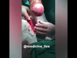 video пациент 55 лет удаление 18 дюймого корня юкки из ануса sex