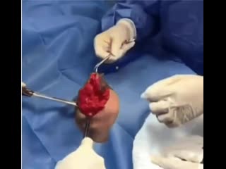 video рак молочной железы злокачественная опухоль железистой ткани молочной железы sex