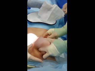 video удаление грудного импланта с комментированием процесса sex