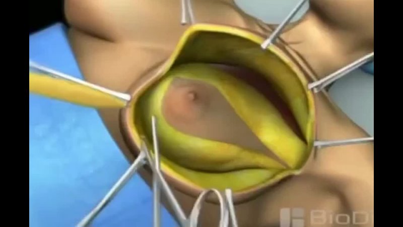 video вариант операции при раке молочной железы sex