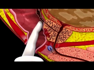 video рак простаты и пальцевое ректальное исследование sex
