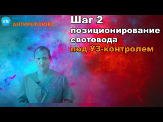 video техника эндовенозной лазерной облитерации лекция 5 позиционирование sex