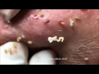 video воспаленные прыщи корочки черные точки sex
