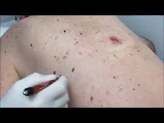video удаление огромных черных точек на спине sex