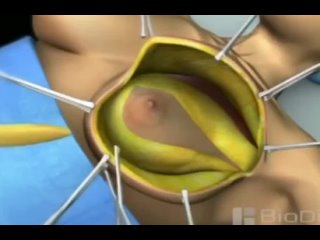 video вариант операции при раке молочной железы sex