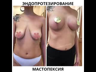 video эндопротезирование молочных желез и мастопексия sex