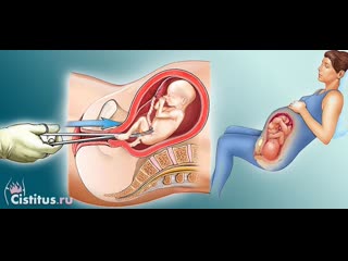 video аборты карма молодые сущность секс замершая беременность уродливый плод sex