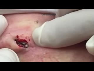 video расширенные поры винера или черные точки sex