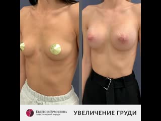 video увеличение груди пластический хирург евгения ермилова sex