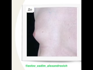 video гинекомастия иссечение гинекомастии медицинский центр umg новосибирск sex