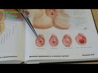 video девственная плева и ее аномалия hymen sex
