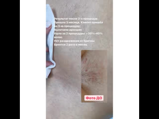video видео от лазерная эпиляция массаж косметология ижевск sex