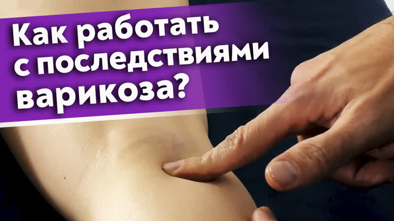video как избавиться от варикоза лечение варикоза массажем sex