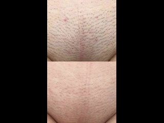 video видео от студия лазерной эпиляция и похудения казань sex
