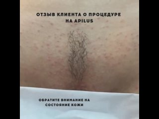 video видео от косметология gigi электроэпиляция apilus sex