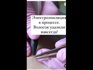 video электроэпиляция в процессе sex