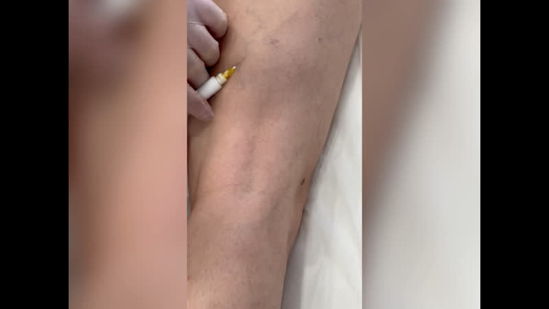 video видео от файбер клиник лечение варикоза лазером sex