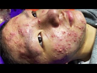 video чертовски привлекательный парень даже с прыщами на лице соблазняет девушек sex