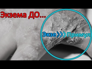 video лечение экземы на кисти руки за 15 месяца до и после крем экзепримул sex