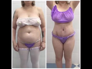 video липоабдоминопластика пластика молодые липосакция секс поясницы талии sex