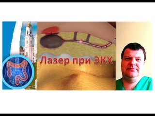 video лазерная операция эпителиальный копчиковый ход киста копчика экх пилонидальная болезнь sex