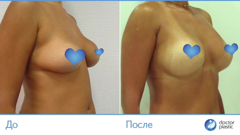 video до и после повторная пластика выполнена в клинике doctorplastic sex