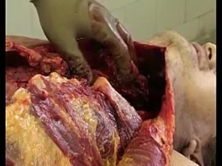 video техника вскрытия трупов в паталого анатомическом отделении sex