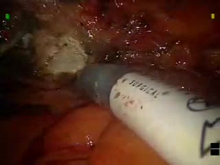 video удаление матки вместе с лимфатическими узлами при раке эндометрия sex