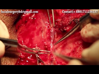 video амелобластома хирургия микрососудистая реконструкция стоматология dr abdullah al masud sex