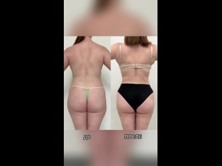 video липосакция молодые поясницы лобка спины крестца плеч галифе внутренней поверхности бедер коленей спустя месяц sex