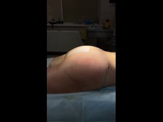 video абдоминопластика липосакция молодые поясницы внутр поверхности бедер колен внешней поверхности бедер крестца лобка sex