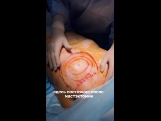 video реконструкция груди после мастэктомии липофилинг груди sex