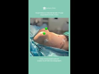 video увеличение груди с периареолярной подтяжкой и липоабдоминопластика в клинике пульс пластический хирург еник г л sex