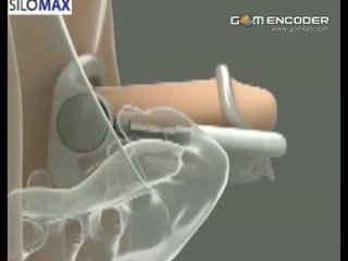 video увеличение члена пениса экстендер большой огромный длинный толстый хуй удлинениебез операции хера sex