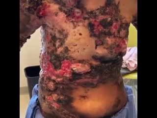 video пациент проходит лечение с распространенным раком молочной железы который распространился на кожу sex