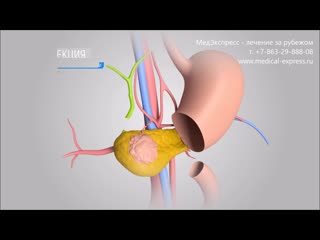 video хирургическое лечение рака поджелудочной железы в германии медэкспресс лечение за рубежом sex