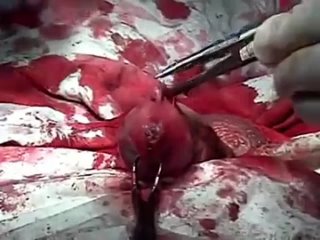 video перелом полового члена хирургическое лечение болезни пейрони sex