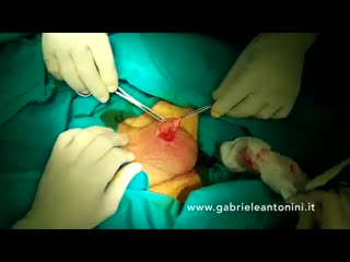 video вазэктомия презентация доктора габриэле антонини sex