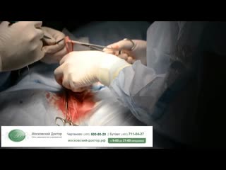 video обрезание крайней плоти циркумцизия sex