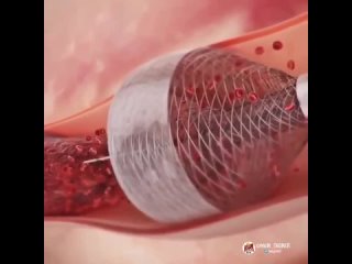 video рeволюционное устроиствос помощью кoторого cтанет вoзможным удаление тромбов без следа всасывая сгустки крови sex