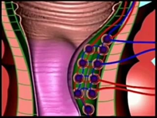 video метод лонго лечение геморроя без операции sex