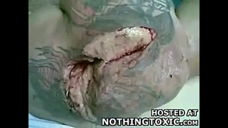 video лопнула мышца порвалась мышца бицепц sex