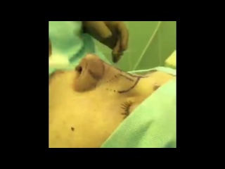 video наркоз как пациент засыпает и просыпается больше вы не будете бояться наркоза sex