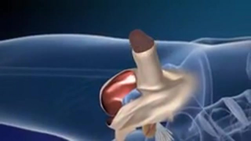 video операция по смене пола sex