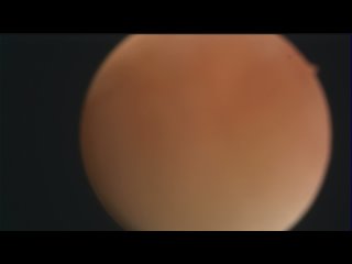 video вагиноскопия удаление новообразований влагалища у молодые sex