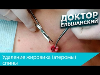 video удаление жировика атеромы спины sex