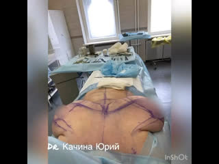 video гигантомастия выполнена редукция молочных желёз sex