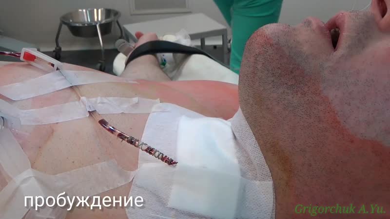 video внутри операционной live surgery циркулярная резекция трахеи стеноз sex