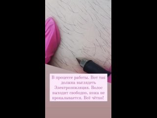video электроэпиляция в процессе sex