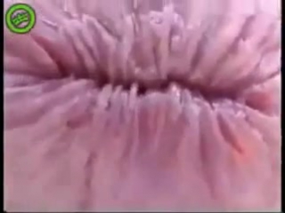 video плавающая анальная трещина мышца сфинктера sex